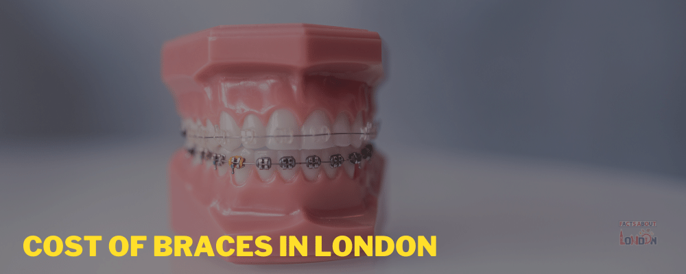 Cost of Braces in London